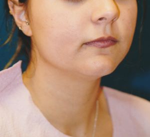 Woman's face, before Submental Lipocontouring treatment, r-side oblique view, patient 10