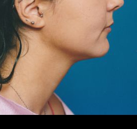 Woman's face, after Submental Lipocontouring treatment, r-side view, patient 10