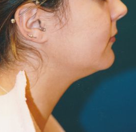 Woman's face, before Submental Lipocontouring treatment, r-side view, patient 10