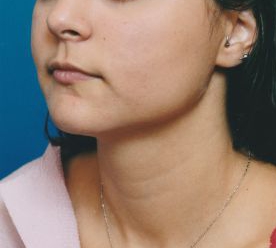 Woman's face, after Submental Lipocontouring treatment, l-side oblique view, patient 10