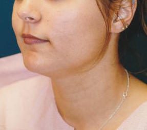 Woman's face, before Submental Lipocontouring treatment, l-side oblique view, patient 10