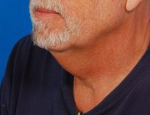 Male face, before Submental Lipocontouring treatment, l-side oblique view, patient 102