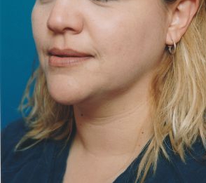 Woman's face, before Submental Lipocontouring treatment, l-side oblique view, patient 11