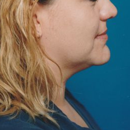 Woman's face, before Submental Lipocontouring treatment, r-side view, patient 11