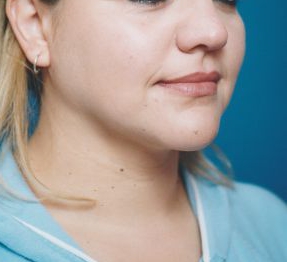 Woman's face, after Submental Lipocontouring treatment, r-side oblique view, patient 11