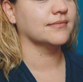 Woman's face, before Submental Lipocontouring treatment, r-side oblique view, patient 11