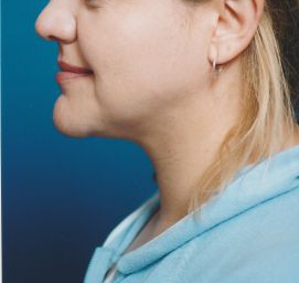 Woman's face, after Submental Lipocontouring treatment, l-side view, patient 11