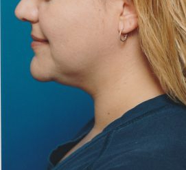 Woman's face, before Submental Lipocontouring treatment, l-side view, patient 11