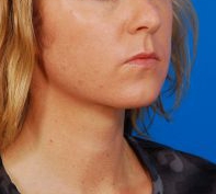 Woman's face, after Submental Lipocontouring treatment, r-side oblique view, patient 12