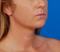 Woman's face, before Submental Lipocontouring treatment, r-side oblique view, patient 12