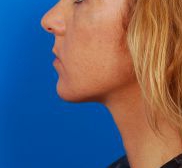 Woman's face, after Submental Lipocontouring treatment, l-side view, patient 12