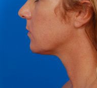 Woman's face, before Submental Lipocontouring treatment, l-side view, patient 12