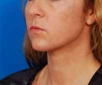 Woman's face, after Submental Lipocontouring treatment, l-side oblique view, patient 12