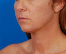 Woman's face, before Submental Lipocontouring treatment, l-side oblique view, patient 12