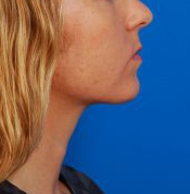 Woman's face, before Submental Lipocontouring treatment, r-side view, patient 12