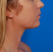 Woman's face, after Submental Lipocontouring treatment, r-side view, patient 12