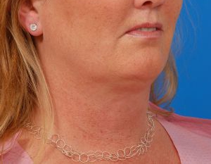 Woman's face, before Submental Lipocontouring treatment, r-side oblique view, patient 2