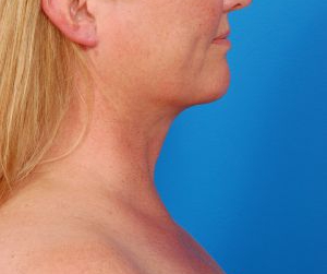 Woman's face, after Submental Lipocontouring treatment, r-side view, patient 2