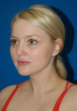 Woman's face, after Submental Lipocontouring treatment, l-side oblique view, patient 3