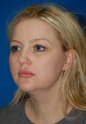 Woman's face, before Submental Lipocontouring treatment, l-side oblique view, patient 3