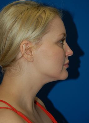 Woman's face, after Submental Lipocontouring treatment, r-side view, patient 3