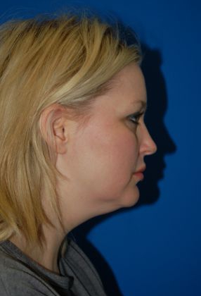 Woman's face, before Submental Lipocontouring treatment, r-side view, patient 3