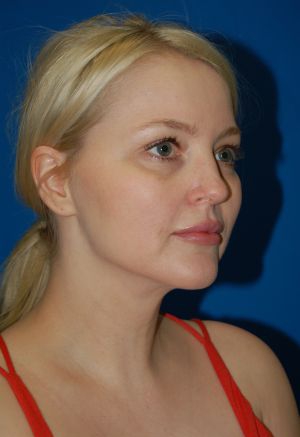 Woman's face, after Submental Lipocontouring treatment, r-side oblique view, patient 3