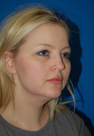 Woman's face, before Submental Lipocontouring treatment, r-side oblique view, patient 3