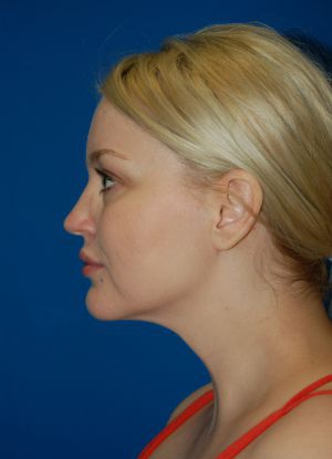 Woman's face, after Submental Lipocontouring treatment, l-side view, patient 3