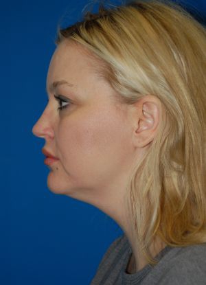 Woman's face, before Submental Lipocontouring treatment, l-side view, patient 3