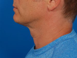 Male face, after Submental Lipocontouring treatment, l-side view, patient 4