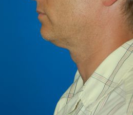 Male face, before Submental Lipocontouring treatment, l-side view, patient 4