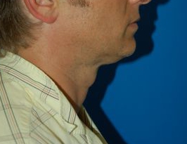 Male face, before Submental Lipocontouring treatment, r-side view, patient 4