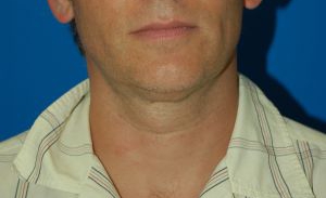 Male face, before Submental Lipocontouring treatment, front view, patient 4