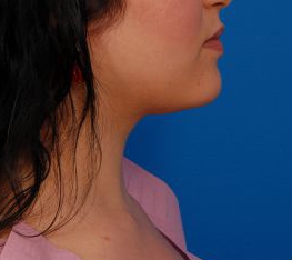 Woman's face, after Submental Lipocontouring treatment, r-side view, patient 5