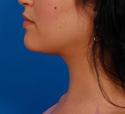 Woman's face, after Submental Lipocontouring treatment, l-side view, patient 5