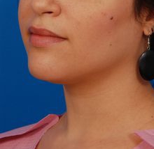 Woman's face, before Submental Lipocontouring treatment, l-side oblique view, patient 5