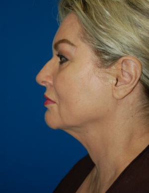 Woman's face, after Submental Lipocontouring treatment, l-side view, patient 6