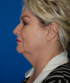 Woman's face, before Submental Lipocontouring treatment, l-side view, patient 6