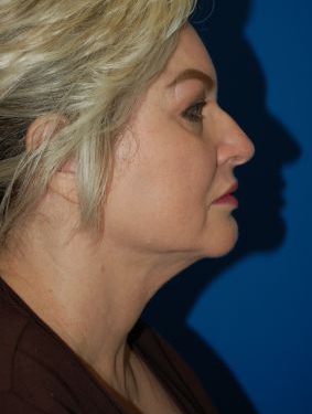Woman's face, after Submental Lipocontouring treatment, r-side view, patient 6