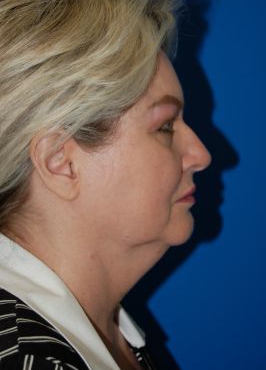 Woman's face, before Submental Lipocontouring treatment, r-side view, patient 6