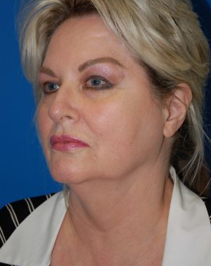 Woman's face, before Submental Lipocontouring treatment, l-side oblique view, patient 6