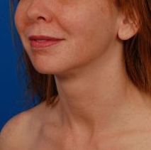 Woman's face, after Submental Lipocontouring treatment, l-side oblique view, patient 66