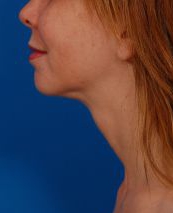 Woman's face, after Submental Lipocontouring treatment, l-side view, patient 66