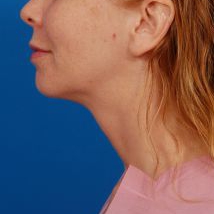 Woman's face, before Submental Lipocontouring treatment, l-side view, patient 66