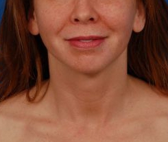 Woman's face, after Submental Lipocontouring treatment, front view, patient 66