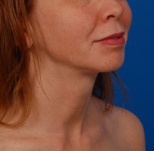 Woman's face, after Submental Lipocontouring treatment, r-side oblique view, patient 66
