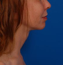 Woman's face, after Submental Lipocontouring treatment, r-side view, patient 66