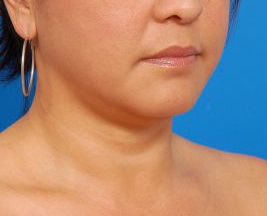 Woman's face, before Submental Lipocontouring treatment, r-side oblique view, patient 7