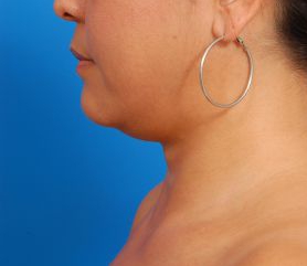 Woman's face, before Submental Lipocontouring treatment, l-side view, patient 7